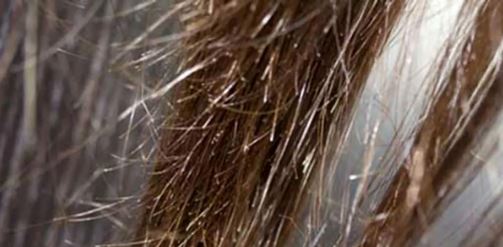 مشکلات مو و پوست سر؛ موخوره